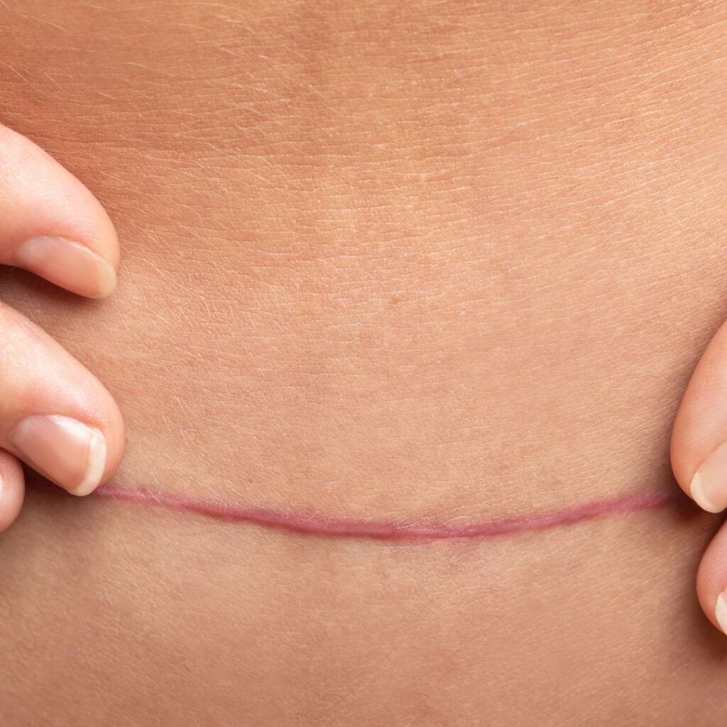 Bruststraffung Narben nach 3 Wochen