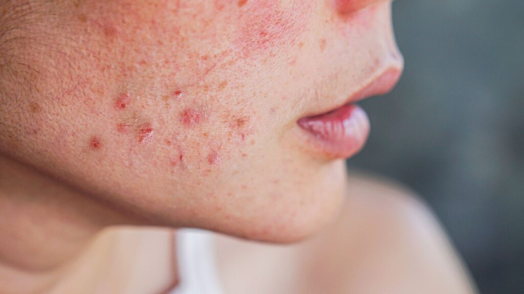 Akne Narben entfernen im Gesicht