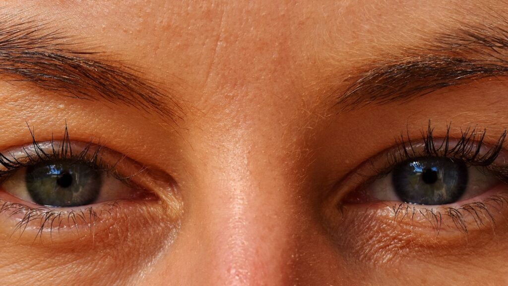 Augenringe mit Hyaluronsäure behandeln