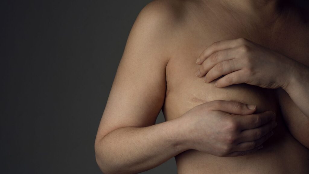 Narben nach der Brustverkleinerung
