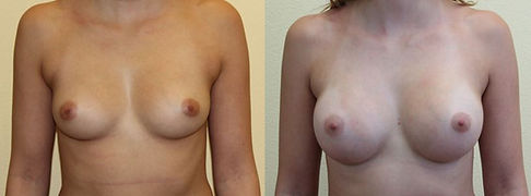 Nach 1 Jahr Brustvergrößerung Eigenfett Vorher Nachher