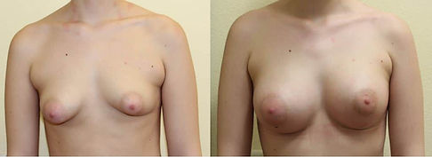 Brustvergrößerung Eigenfett Vorher-Nachher-Bilder