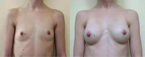Brustvergrößerung mit Eigenfett: Vorher-Nachher-Bilder